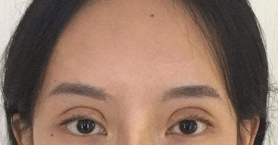 雙眼皮失敗 雙眼皮失敗