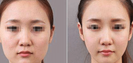 溶脂針前后對比 溶脂針前后對比