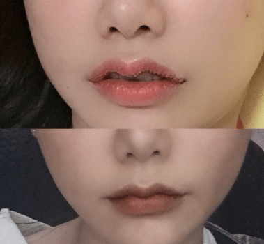m唇前后對比 m唇前后對比