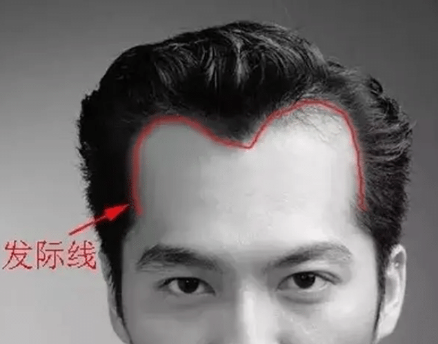 高發(fā)際線 高發(fā)際線