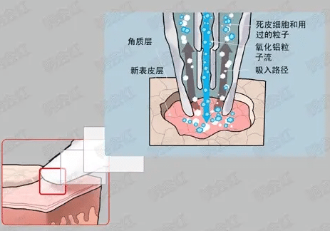 微晶削磨去除疤痕 微晶削磨去除疤痕