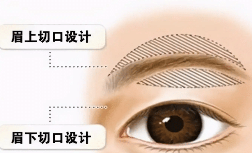 提眉術(shù)
