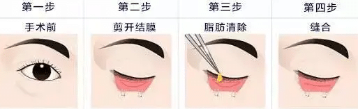 內(nèi)切法祛眼袋 內(nèi)切法祛眼袋
