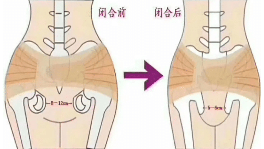 盆骨修復(fù)前后對(duì)比 盆骨修復(fù)前后對(duì)比