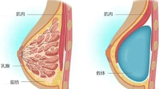 假體隆胸 假體隆胸