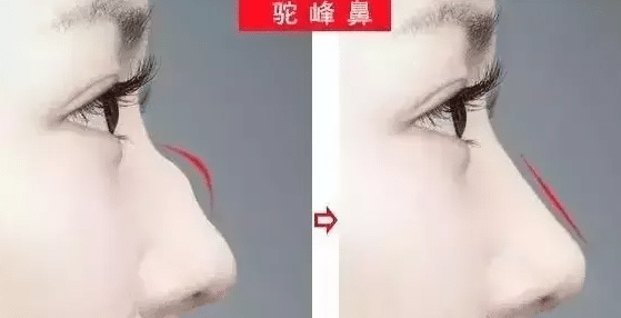 駝峰鼻前后對比 駝峰鼻前后對比