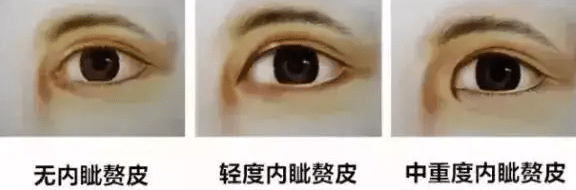 內(nèi)眥贅皮 內(nèi)眥贅皮