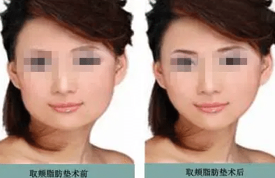 去頰脂墊瘦臉前后對(duì)比 去頰脂墊瘦臉前后對(duì)比