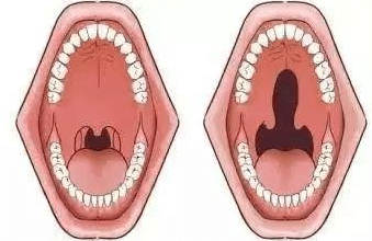 腭隱裂 腭隱裂