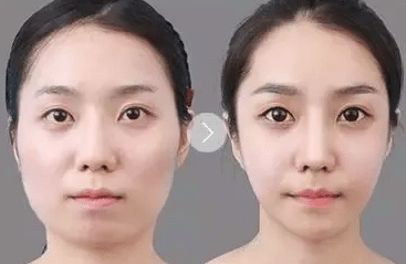 瘦臉針前后對(duì)比 瘦臉針前后對(duì)比