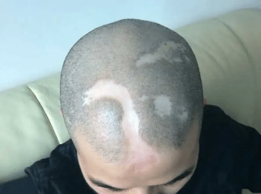 什么是疤痕植發(fā)？疤痕植發(fā)術(shù)后該如何護(hù)理？