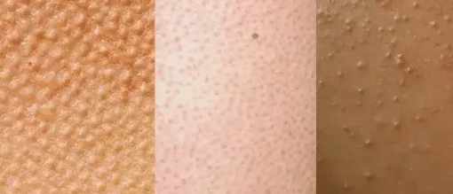 雞皮膚 雞皮膚