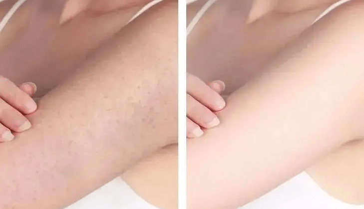 雞皮膚改善前后對比 雞皮膚改善前后對比