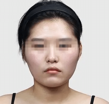 骨骼寬大型臉胖 骨骼寬大型臉胖
