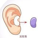 耳軟骨