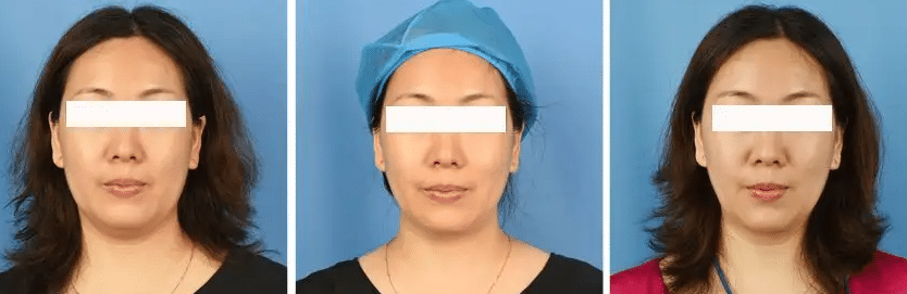 超聲炮前后對比 超聲炮前后對比