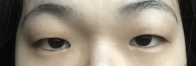 脂肪腫型眼睛 脂肪腫型眼睛