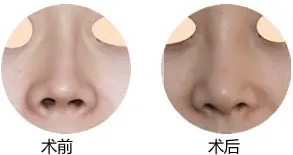 朝天鼻前后對(duì)比 朝天鼻前后對(duì)比