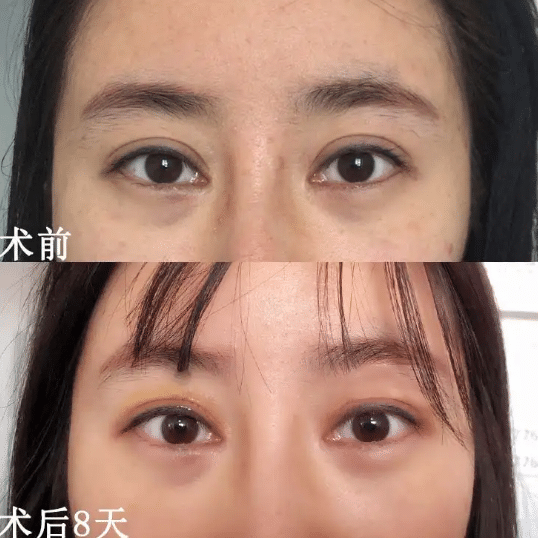 雙眼皮過寬修復(fù)前后對比
