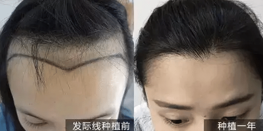 發(fā)際線種植前后對比 發(fā)際線種植前后對比
