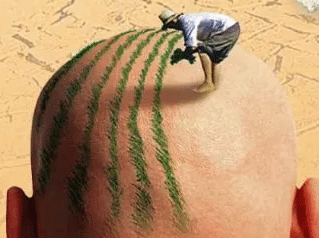 植發(fā) 植發(fā)