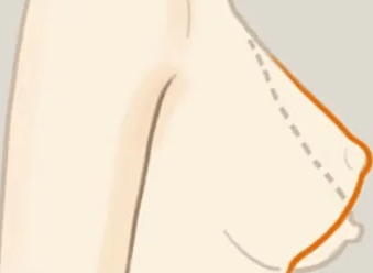 乳房下垂矯正手術(shù)的危險|術(shù)后如何正確護(hù)理？