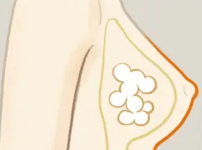 自體脂肪隆胸 自體脂肪隆胸
