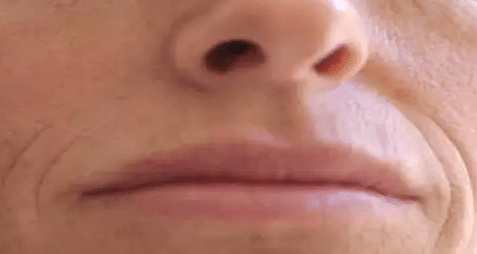 嘴角紋 嘴角紋