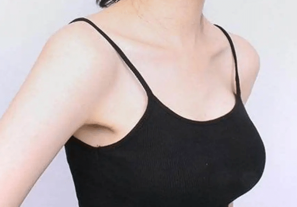 乳房下垂