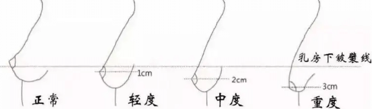 乳房下垂矯正
