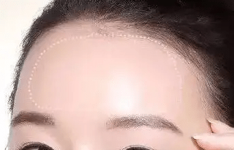 膨體豐額頭手術效果怎么樣？術后會不會出現腫脹？