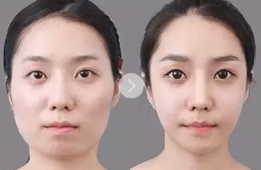 瘦臉針 瘦臉針