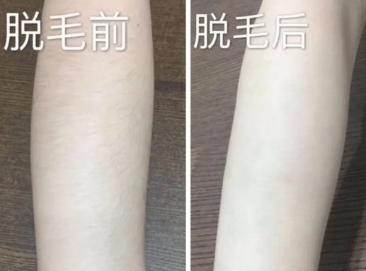 激光脫毛前后對(duì)比 激光脫毛前后對(duì)比