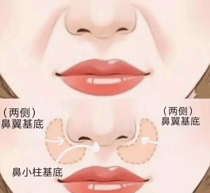 鼻基底自測方法及填充方法！注射填充、手術(shù)填充