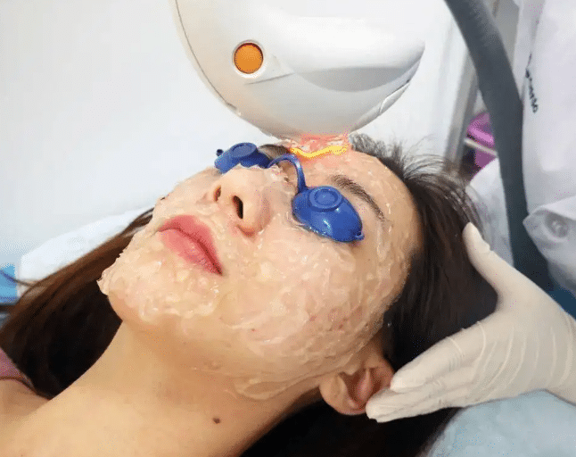 光子嫩膚 光子嫩膚