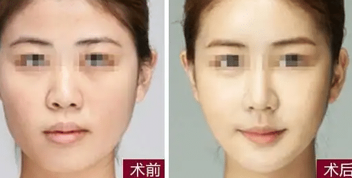 注射瘦臉前后對(duì)比
