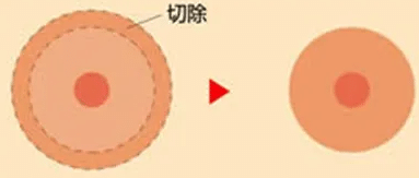 乳暈縮小 乳暈縮小