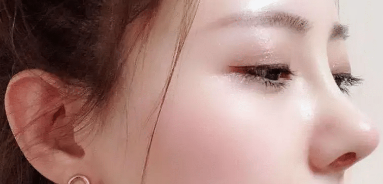 隆鼻后鼻子透光 隆鼻后鼻子透光