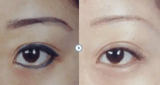 激光洗眉前后對比 激光洗眉前后對比