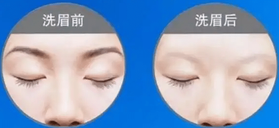 激光洗眉前后對(duì)比 激光洗眉前后對(duì)比