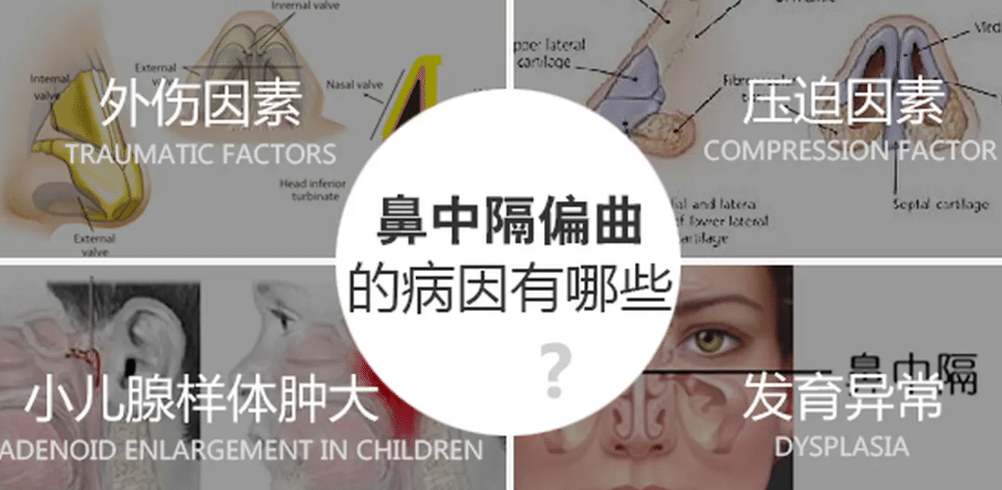 鼻中隔偏曲 鼻中隔偏曲