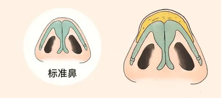 鼻頭縮小手術(shù)有無(wú)副作用？應(yīng)術(shù)后應(yīng)該注意什么？