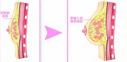自體脂肪隆胸前后變化 自體脂肪隆胸前后變化