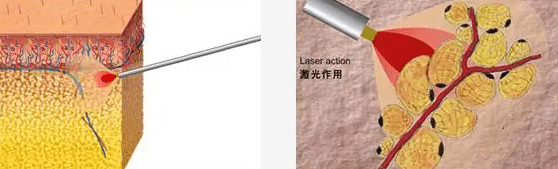 光纖溶脂