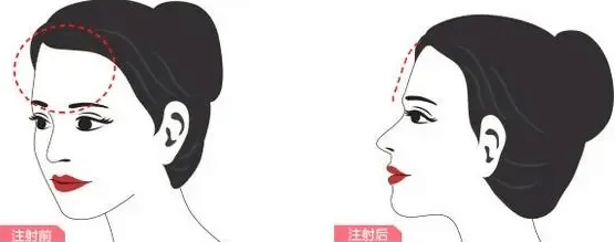 自體脂肪豐額頭 自體脂肪豐額頭