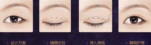 高分子壓雙眼皮 高分子壓雙眼皮
