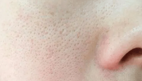 毛孔粗大 毛孔粗大