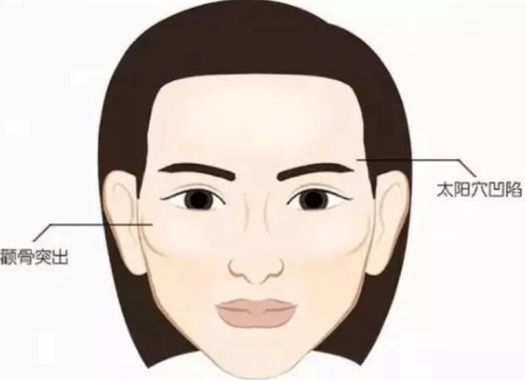 太陽穴凹陷 太陽穴凹陷
