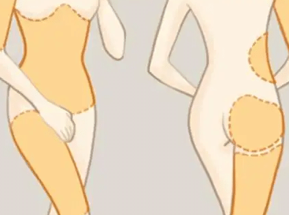 吸脂減肥 吸脂減肥