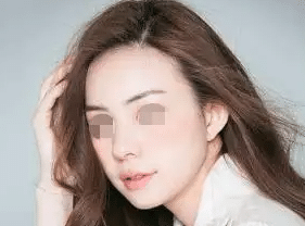 發(fā)際線種植 發(fā)際線種植